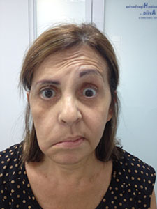 Paralisis Facial Periferica 2